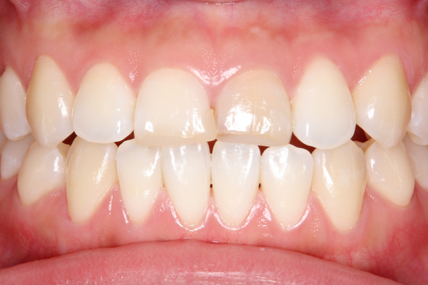 審美歯科症例集 | 北区 十条 歯科 | 百瀬歯科医院
