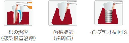 根の治療 歯槽膿漏 インプラント周囲炎