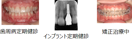 歯周病定期健診 インプラント定期健診 矯正治療中