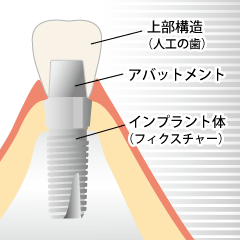 インプラント構造